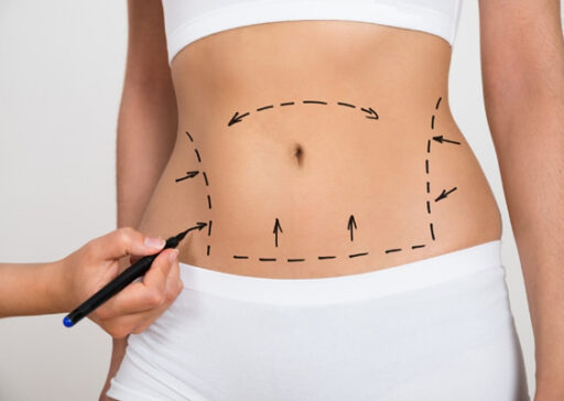 ABDOMINOPLASTIA