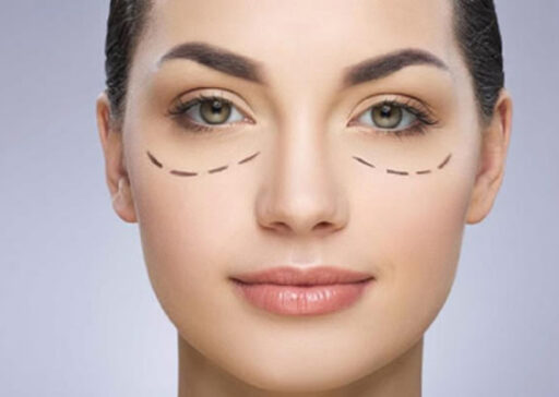 BLEFAROPLASTIA